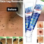 "Natural wart remover cream with herbal extract for warts, moles, and skin tags. Gentle, fast-acting, and antibacterial."